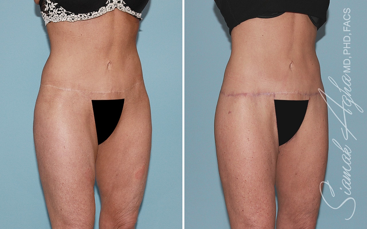 High-Definition Lower Body Lift™ Before & After