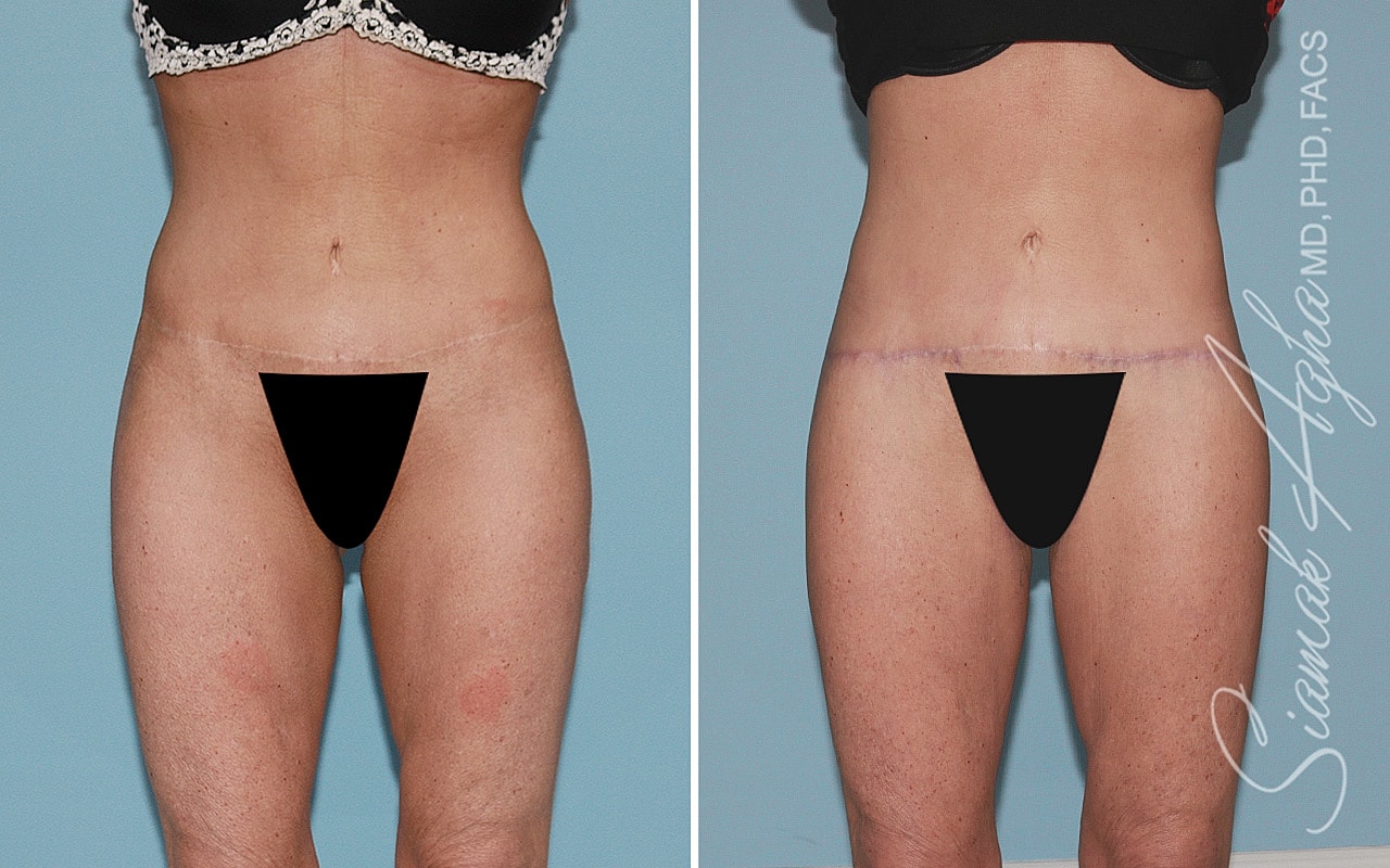 High-Definition Lower Body Lift™ Before & After