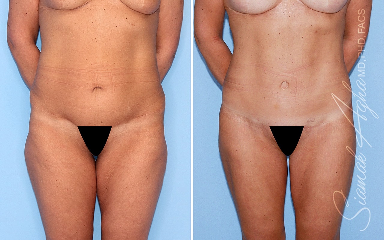 High-Definition Lower Body Lift™ Before & After