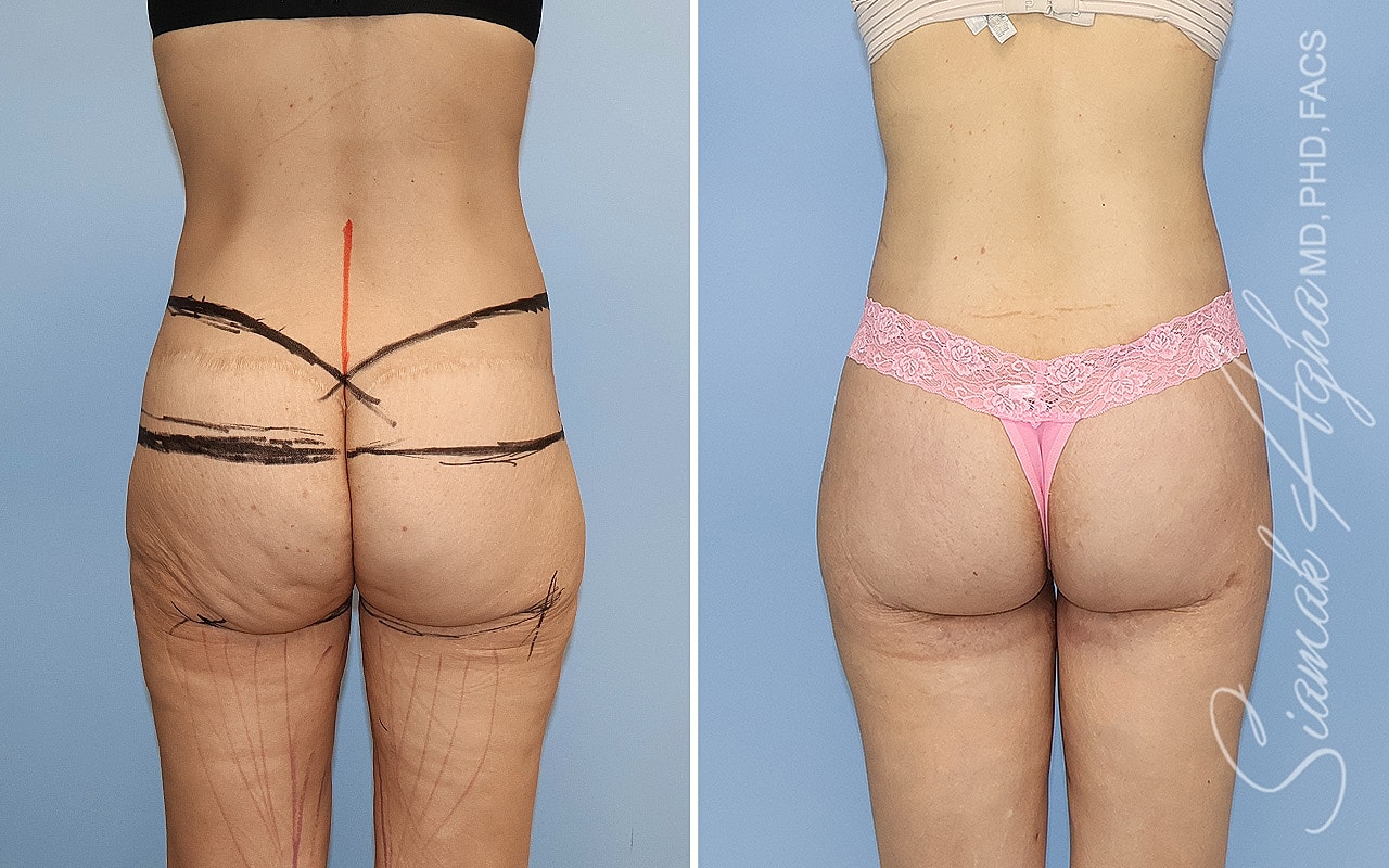 High-Definition Lower Body Lift™ Before & After