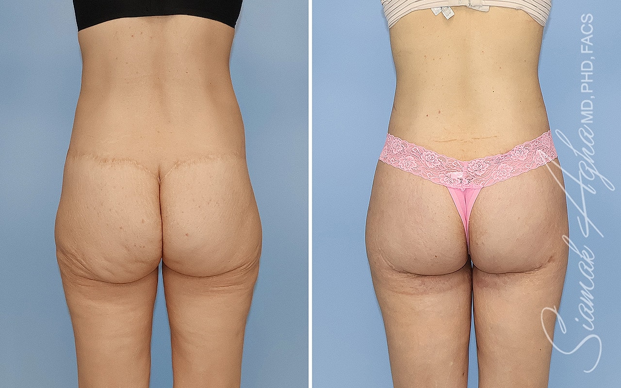 High-Definition Lower Body Lift™ Before & After