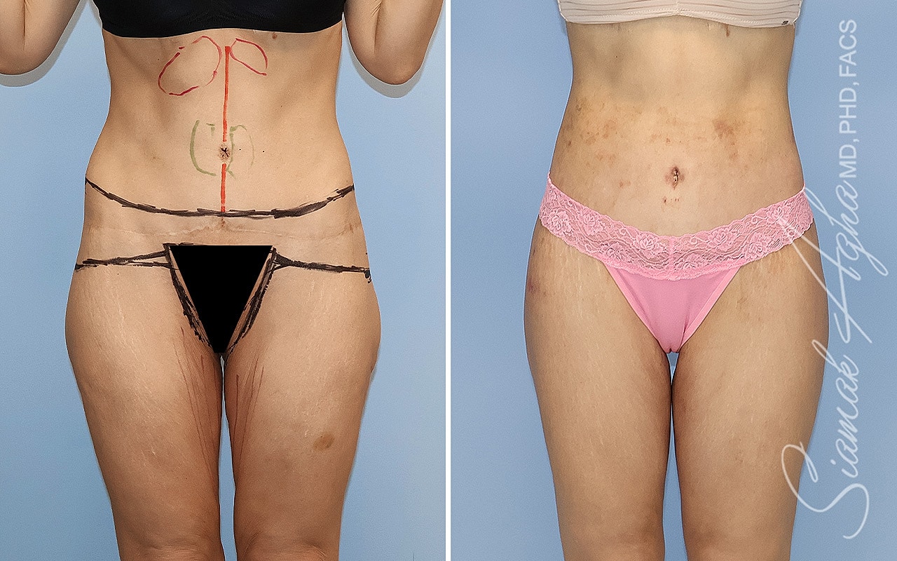 High-Definition Lower Body Lift™ Before & After