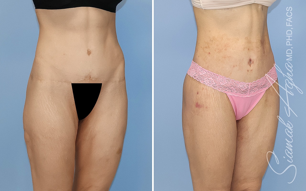 High-Definition Lower Body Lift™ Before & After