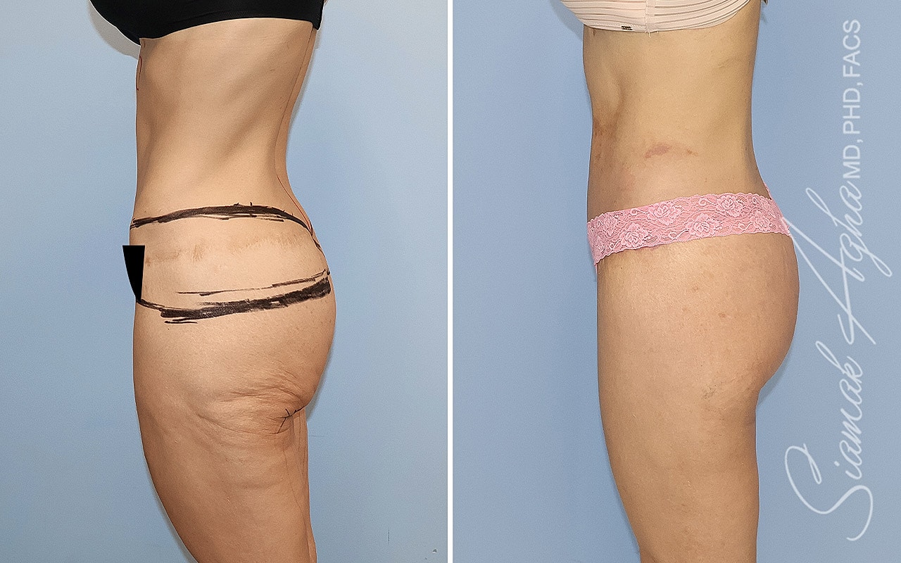High-Definition Lower Body Lift™ Before & After