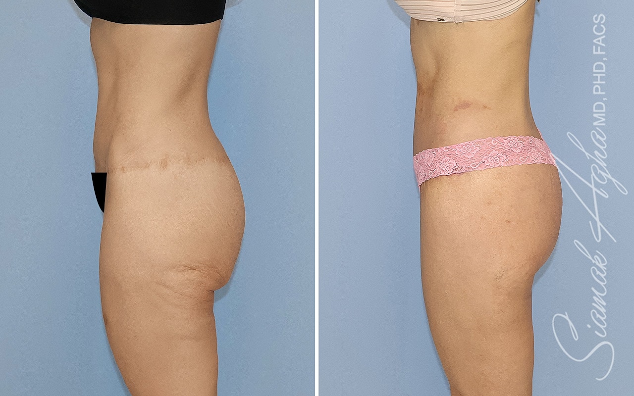 High-Definition Lower Body Lift™ Before & After