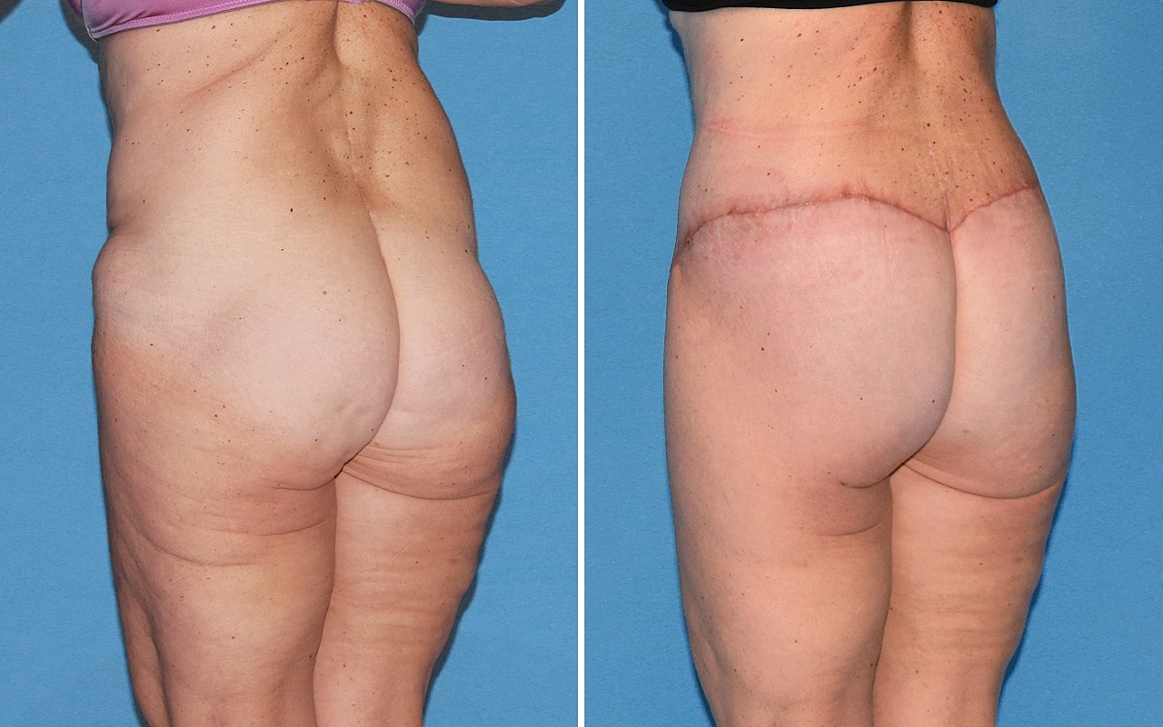 Lower Body Lift Before & After