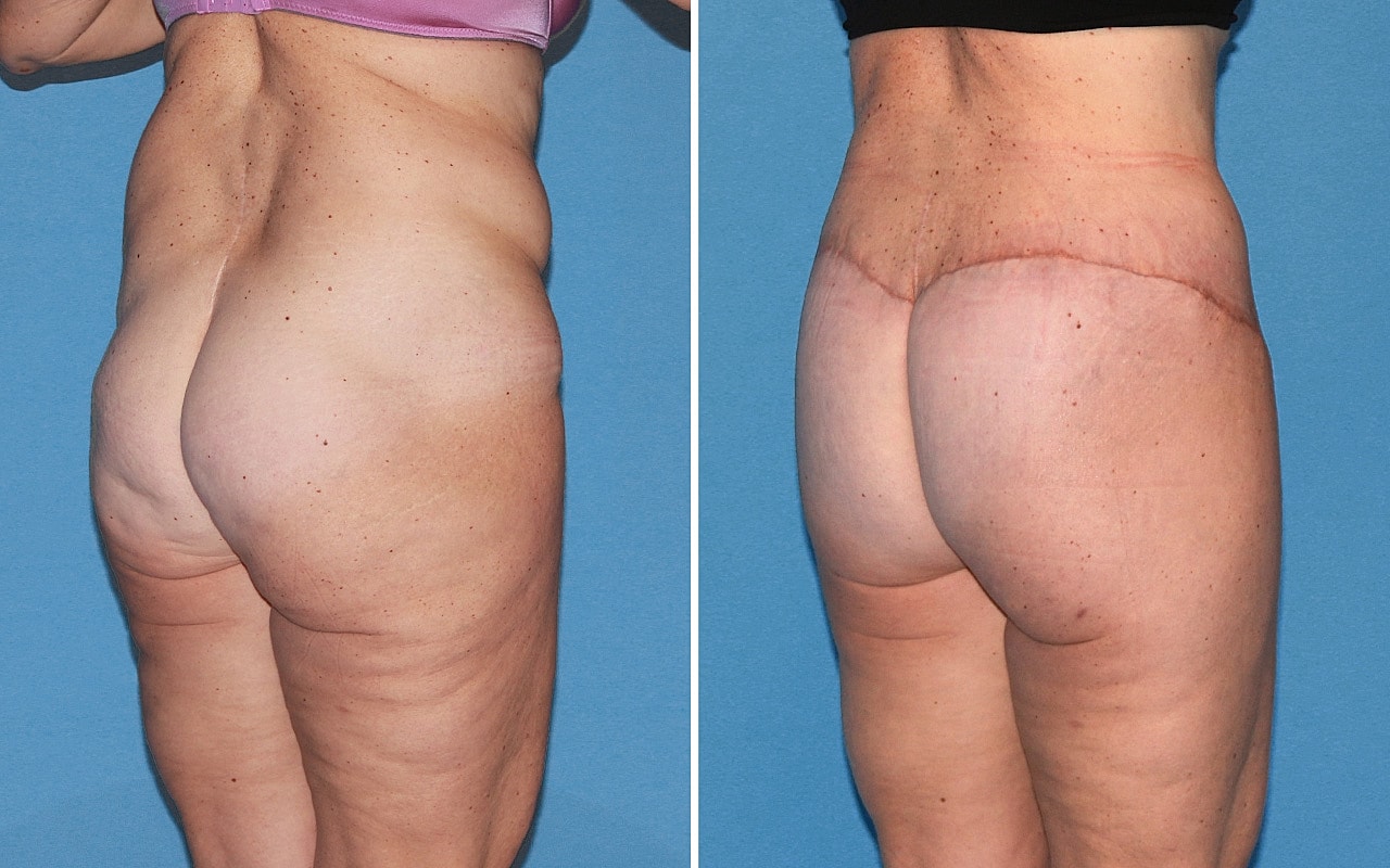 Lower Body Lift Before & After