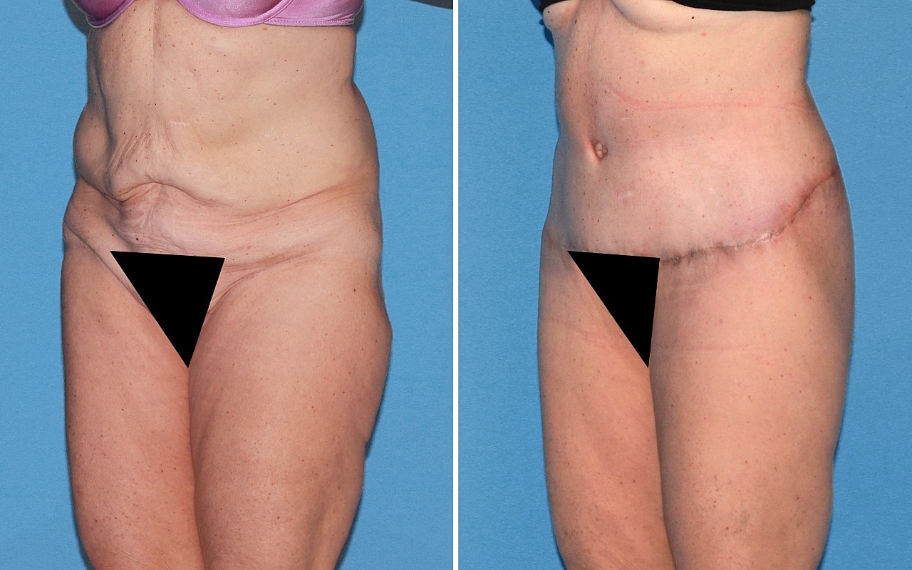 Lower Body Lift Before & After