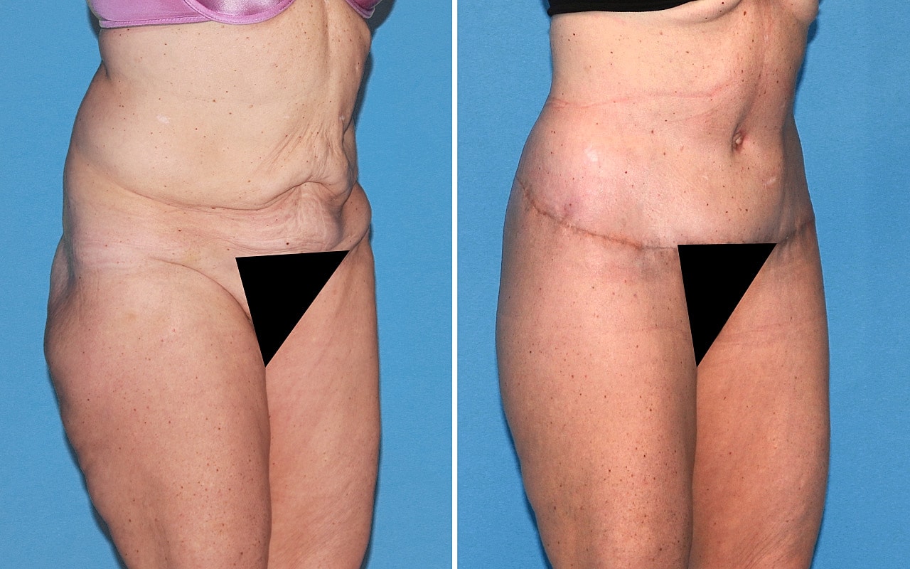 High-Definition Lower Body Lift™ Before & After