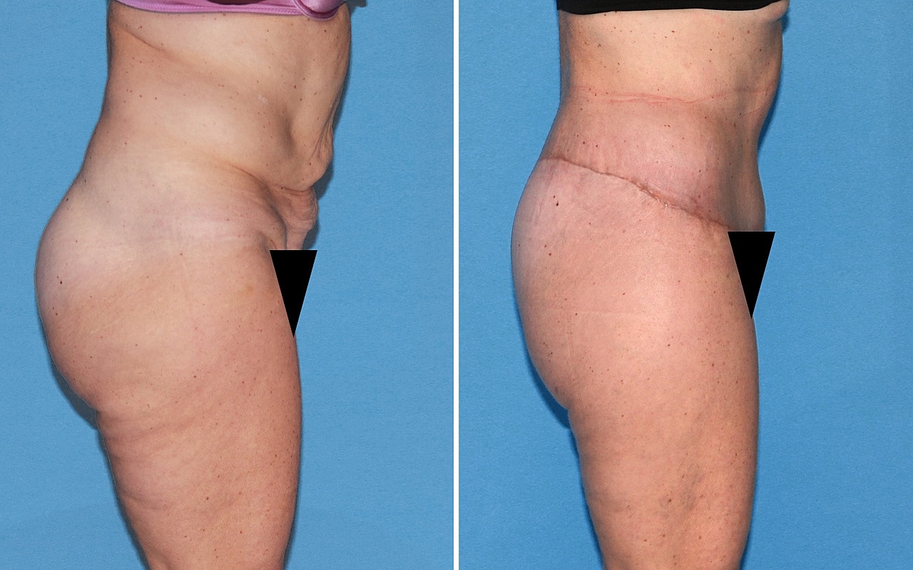 Lower Body Lift Before & After