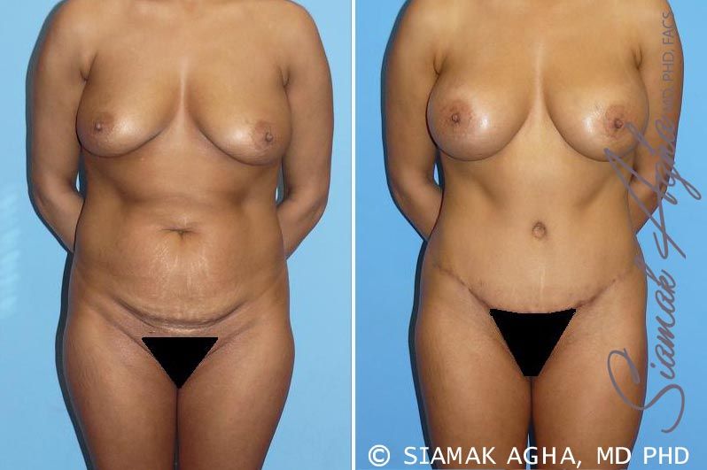 Mommy Makeover Before & After