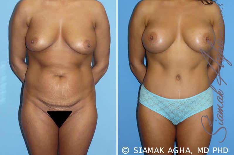 Mommy Makeover Before & After