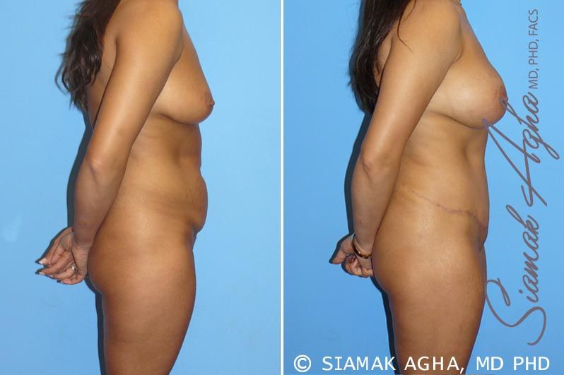 Mommy Makeover Before & After