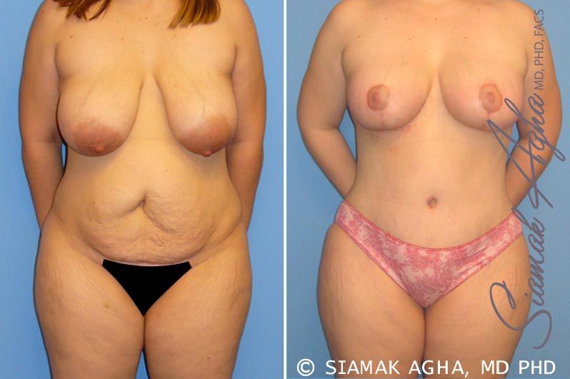 Mommy Makeover Before & After