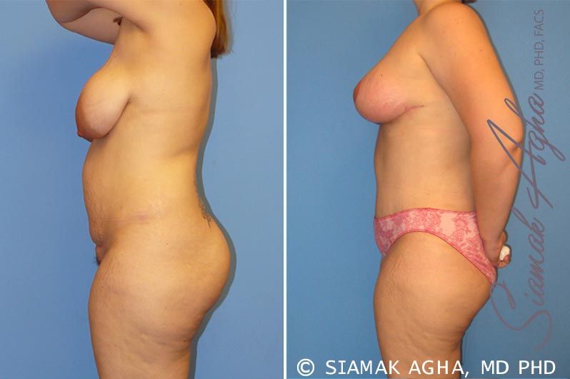 Mommy Makeover Before & After