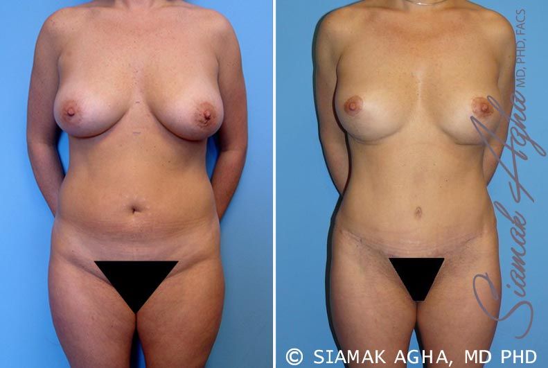 Mommy Makeover Before & After