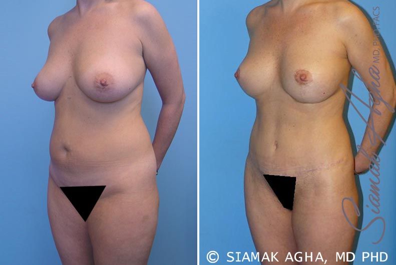 Mommy Makeover Before & After