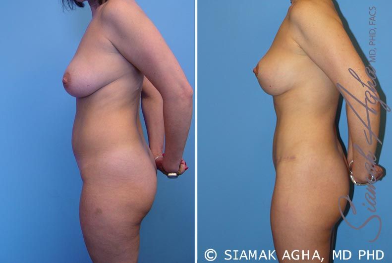 Mommy Makeover Before & After