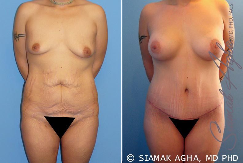 Mommy Makeover Before & After