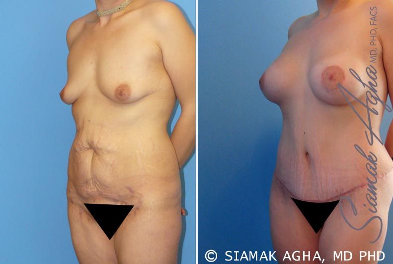 Mommy Makeover Before & After