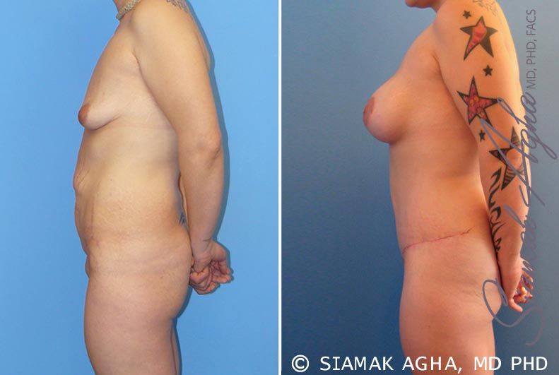 Mommy Makeover Before & After