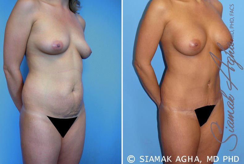 Mommy Makeover Before & After