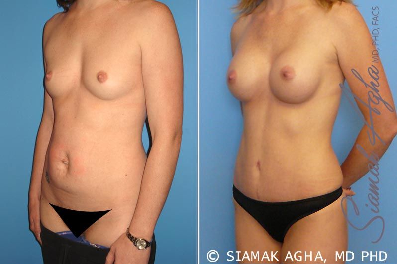 Mommy Makeover Before & After