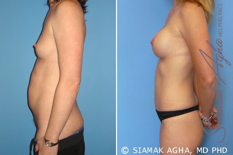 Mommy Makeover Before & After