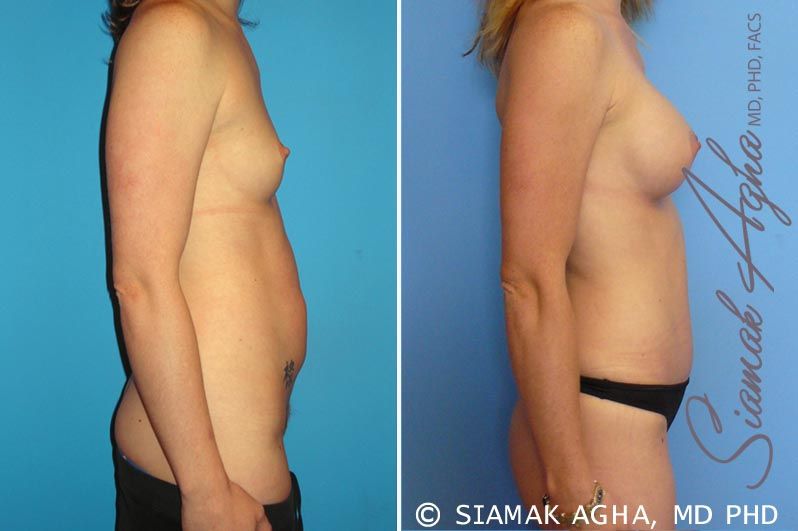 Mommy Makeover Before & After