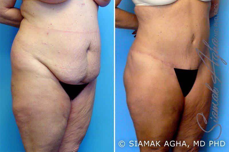 Mommy Makeover Before & After