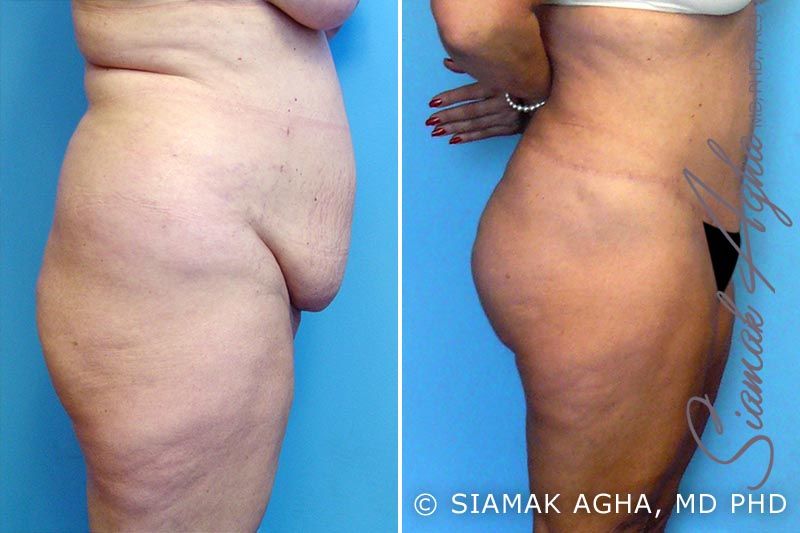 Mommy Makeover Before & After