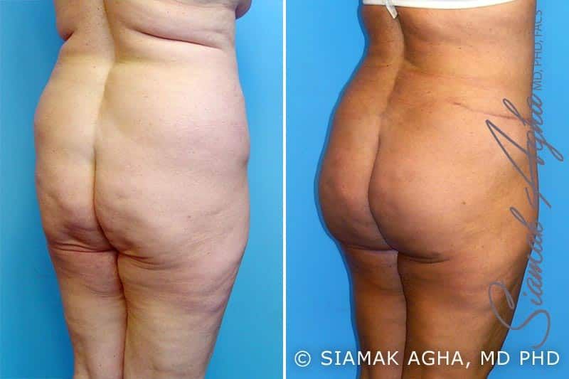 Mommy Makeover Before & After