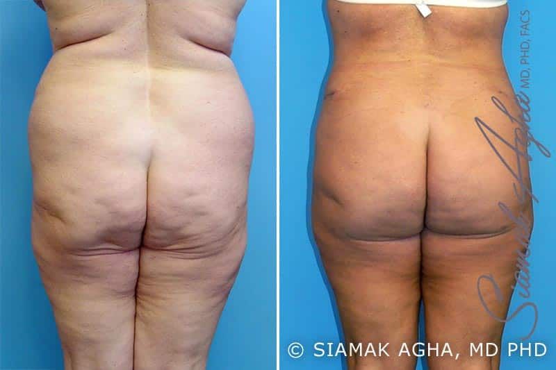 Mommy Makeover Before & After