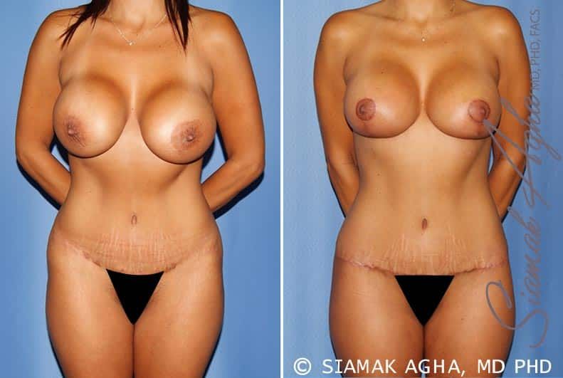 Mommy Makeover Before & After