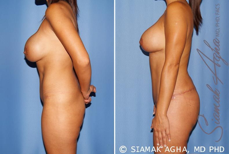 Mommy Makeover Before & After