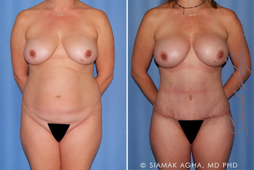 Mommy Makeover Before & After