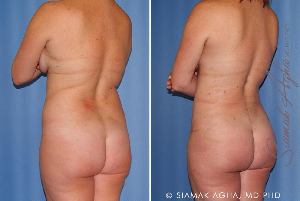 Mommy Makeover Before & After