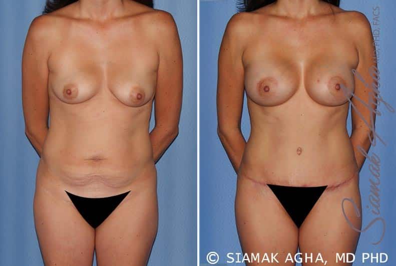 Mommy Makeover Before & After