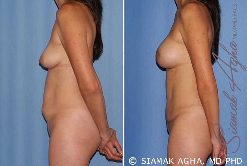 Mommy Makeover Before & After