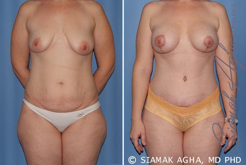 Mommy Makeover Before & After