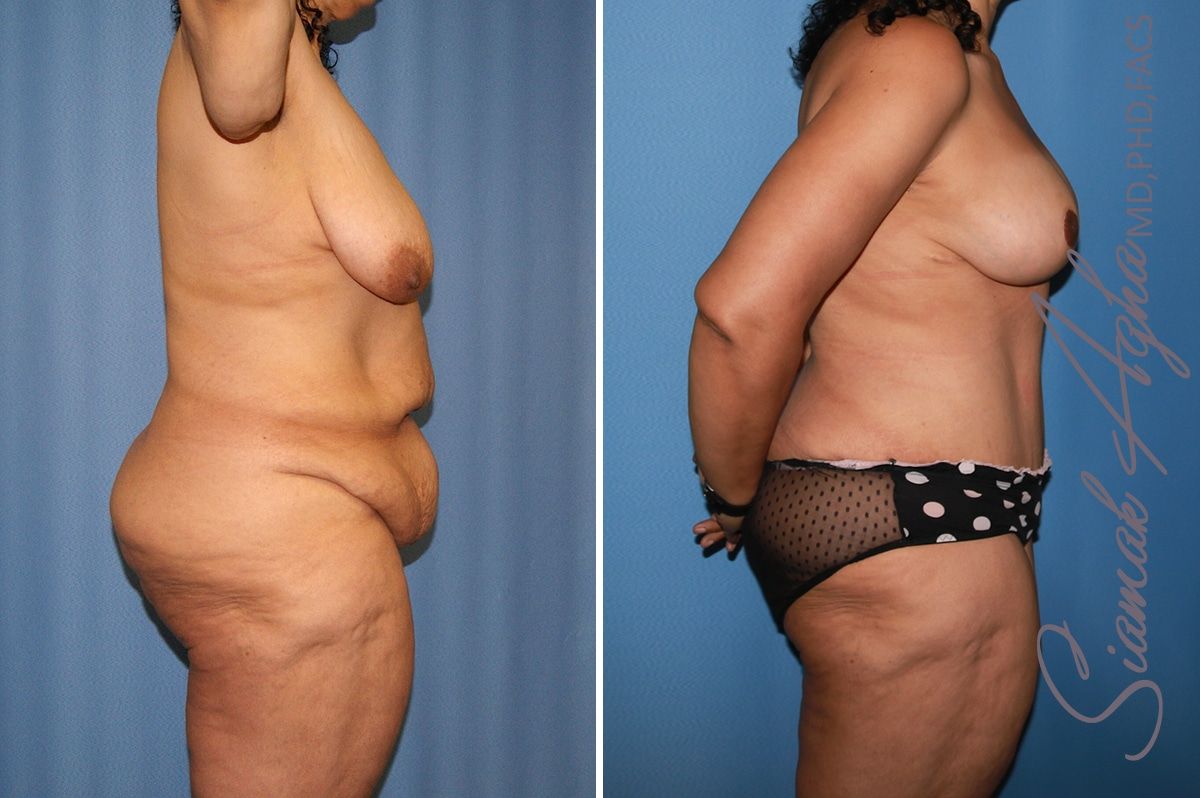 Mommy Makeover Before & After