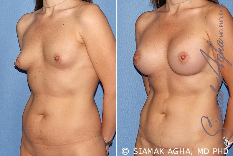 Mommy Makeover Before & After