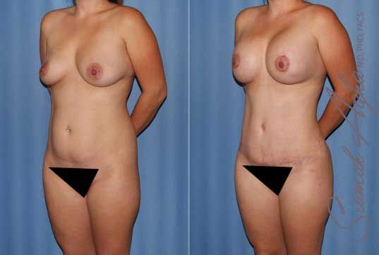 Mommy Makeover Before & After