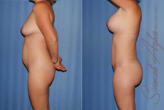 Mommy Makeover Before & After