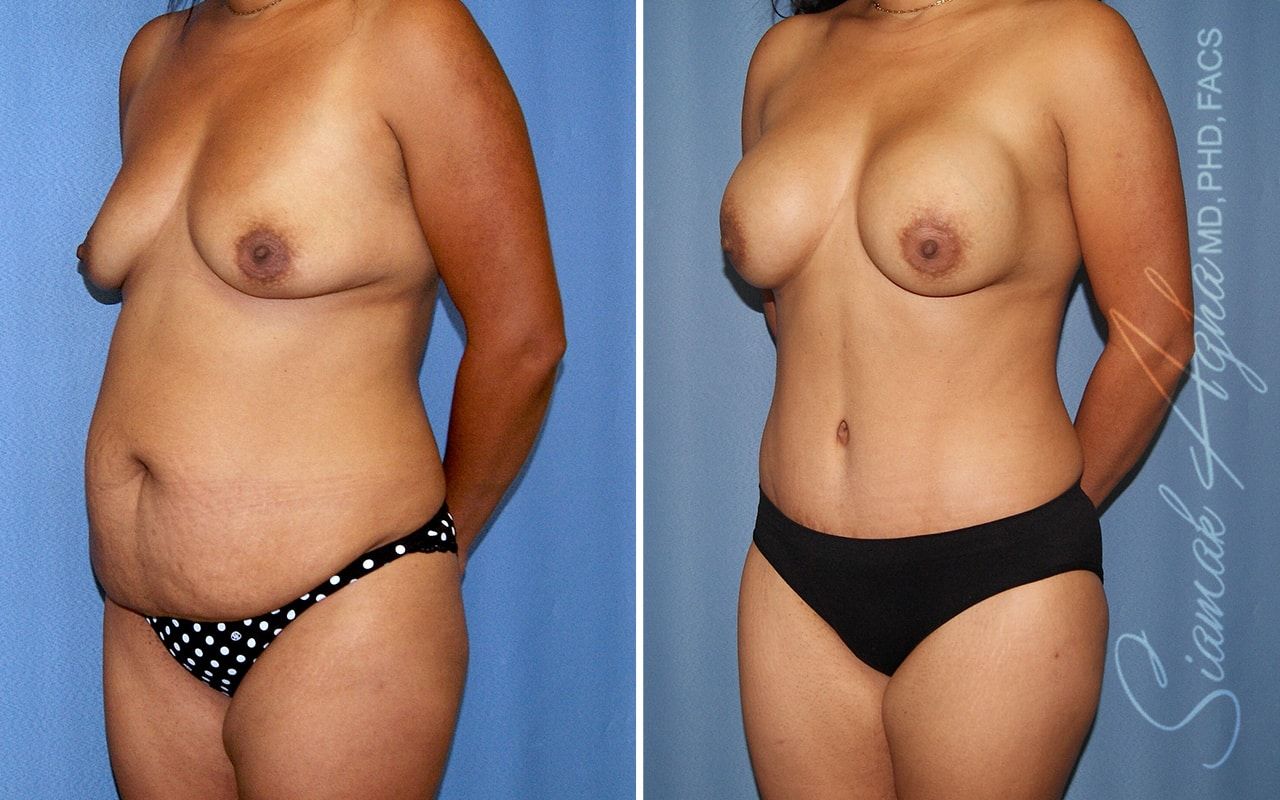 Mommy Makeover Before & After