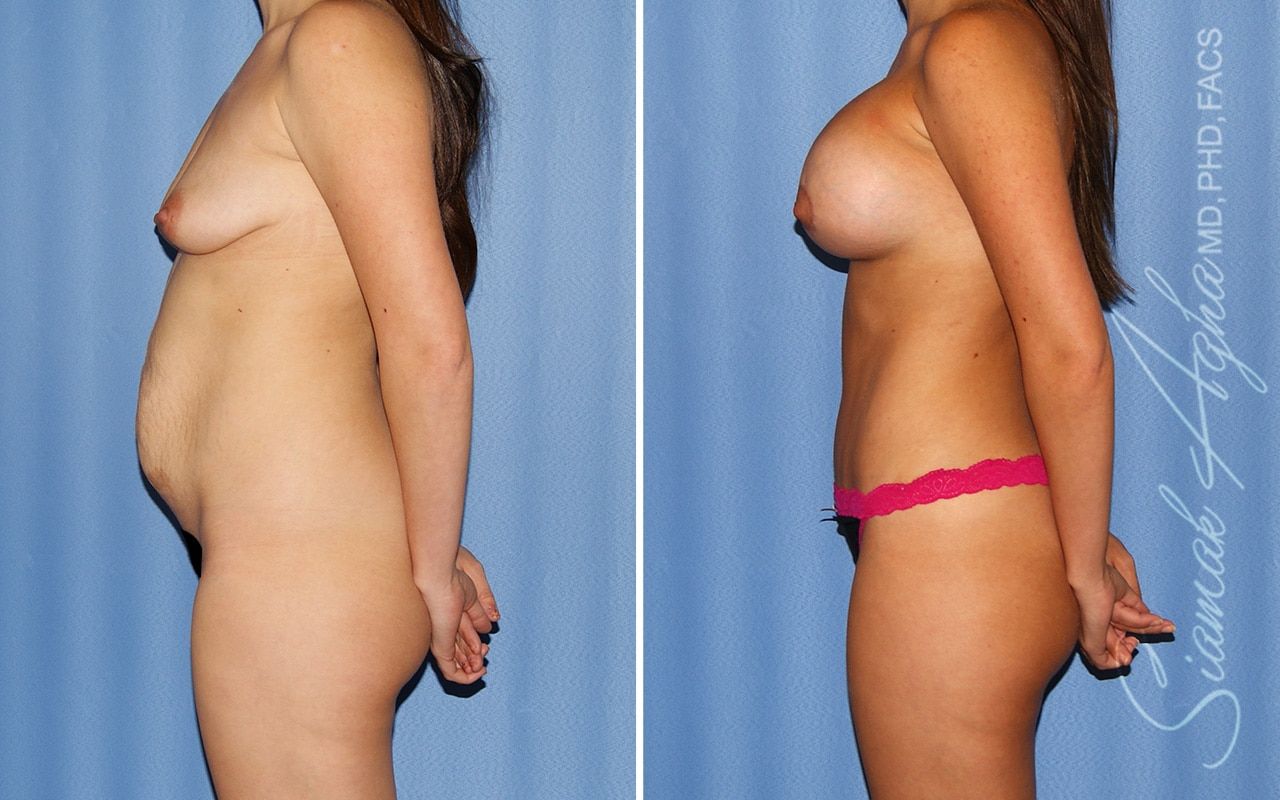 Mommy Makeover Before & After