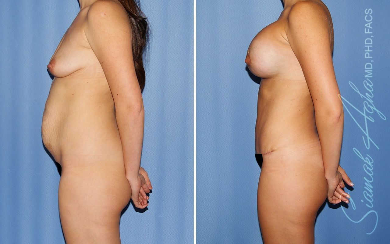 Mommy Makeover Before & After