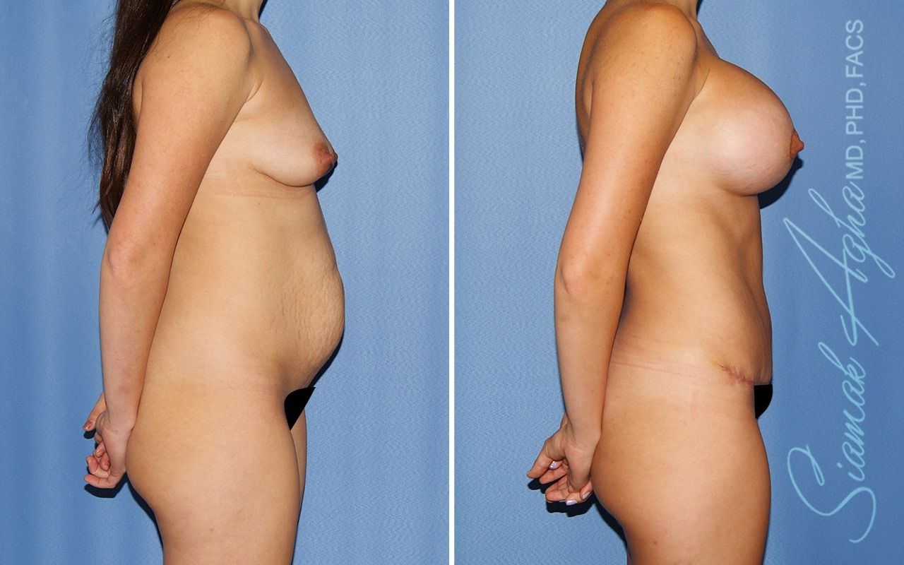 Mommy Makeover Before & After