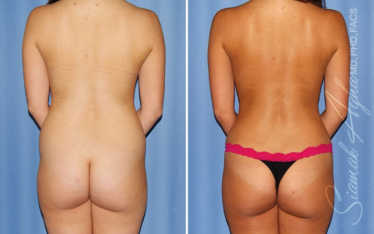 Mommy Makeover Before & After