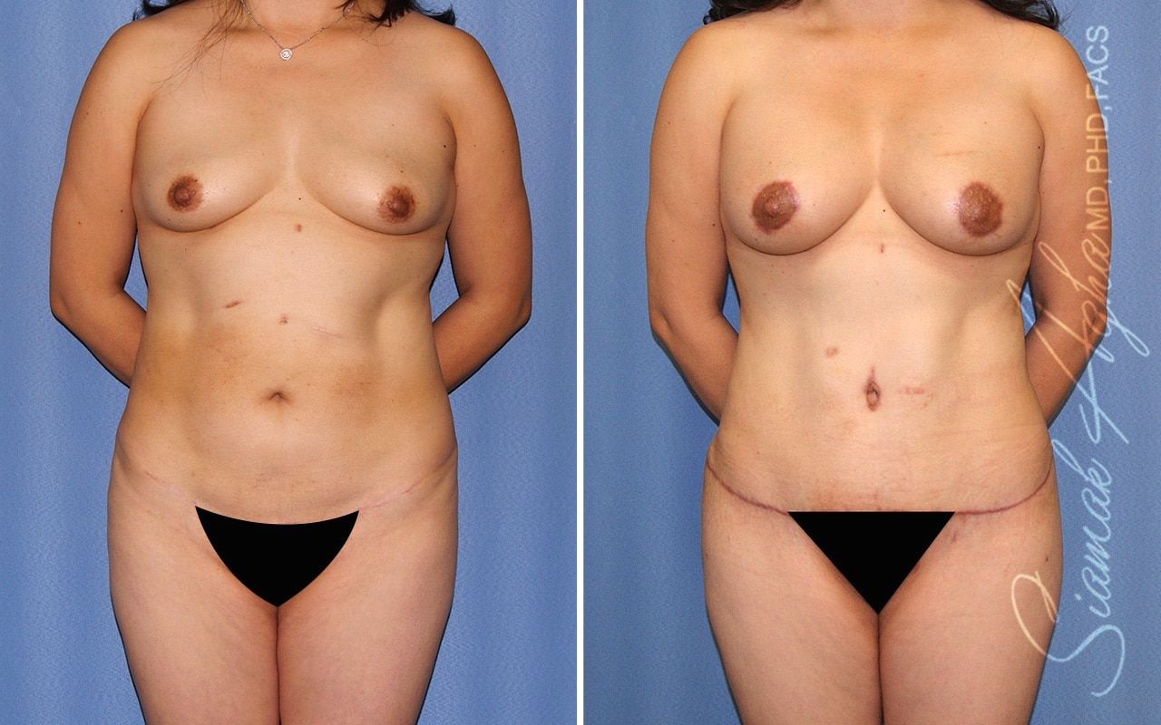 Mommy Makeover Before & After